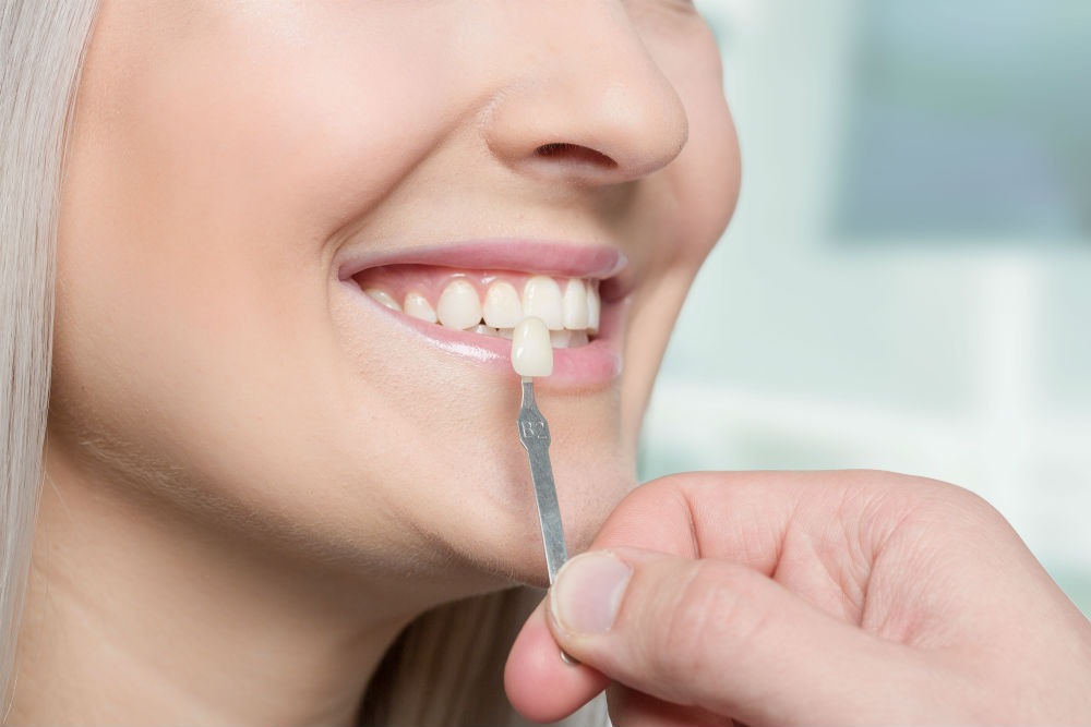 composite dental bonding